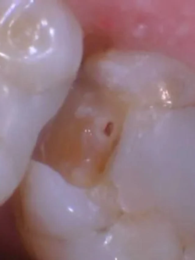 Kill Tooth Pain Nerve in 3 Seconds Permanently